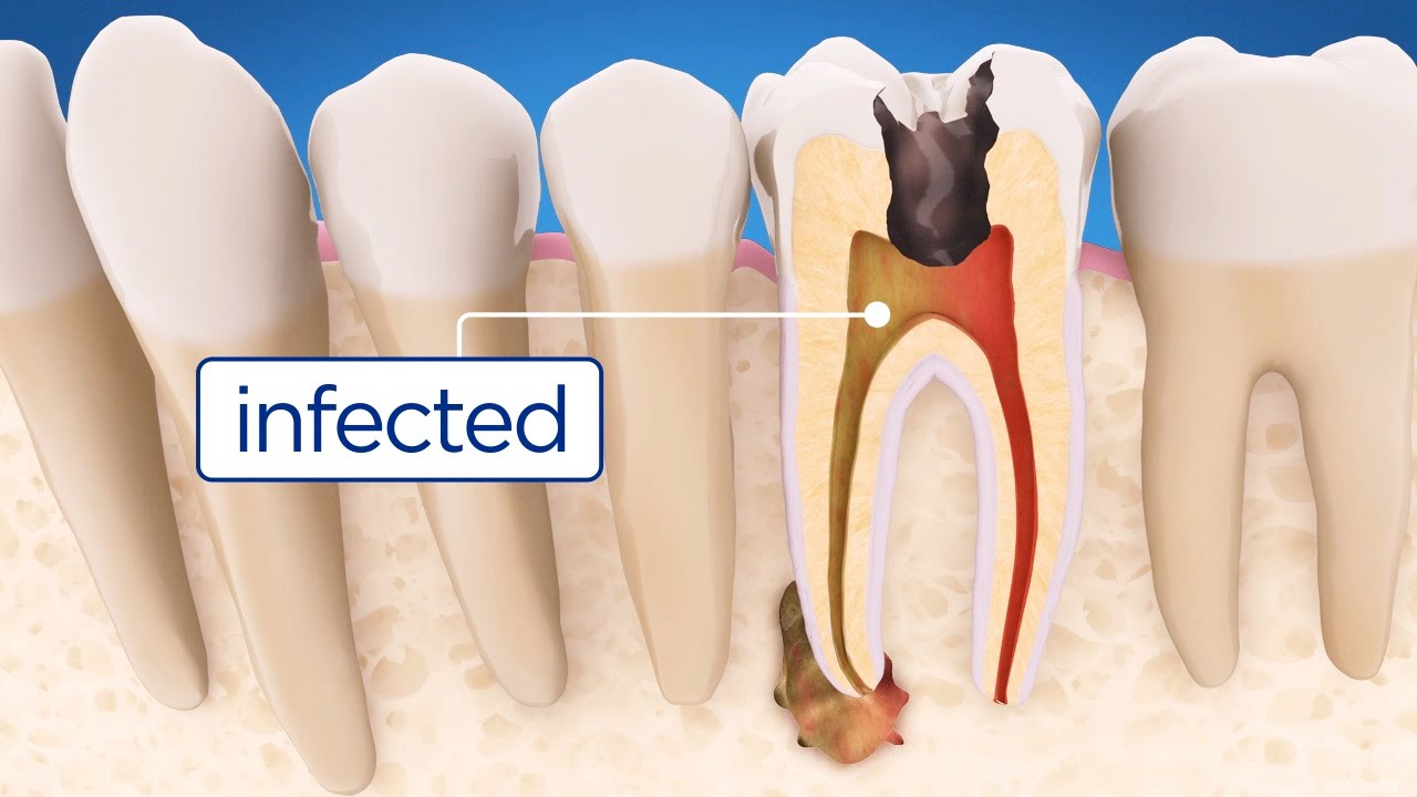 How long does a Root Canal take? Procedure of Root Canal